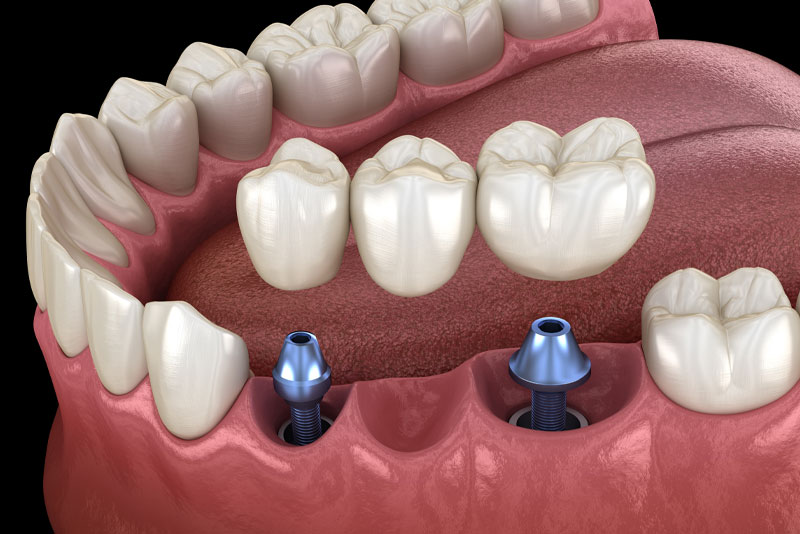 Dental Implant Crown Model