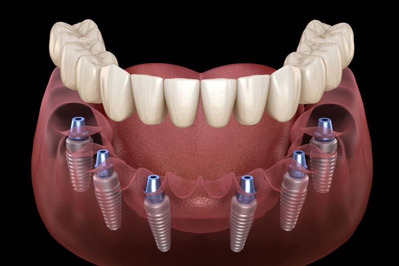 Dental Implants Model