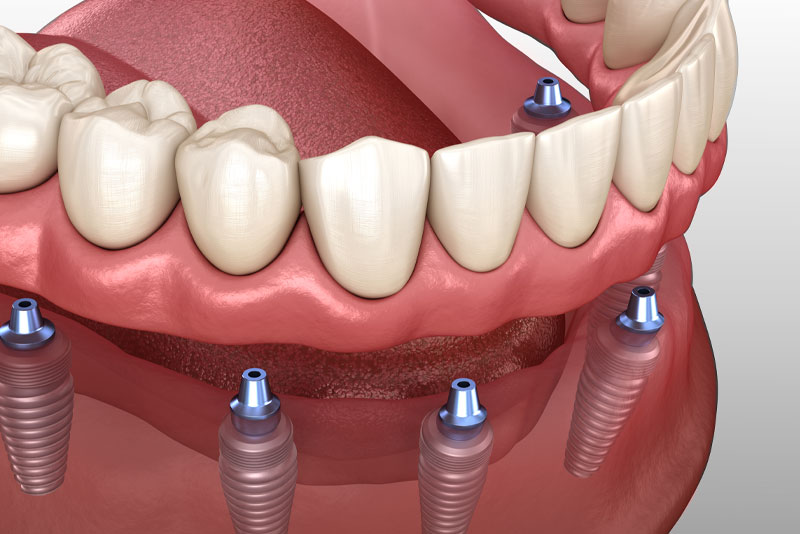 Dental Implants Model