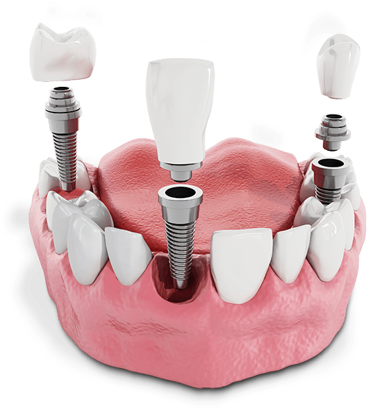 Multiple dental implants model