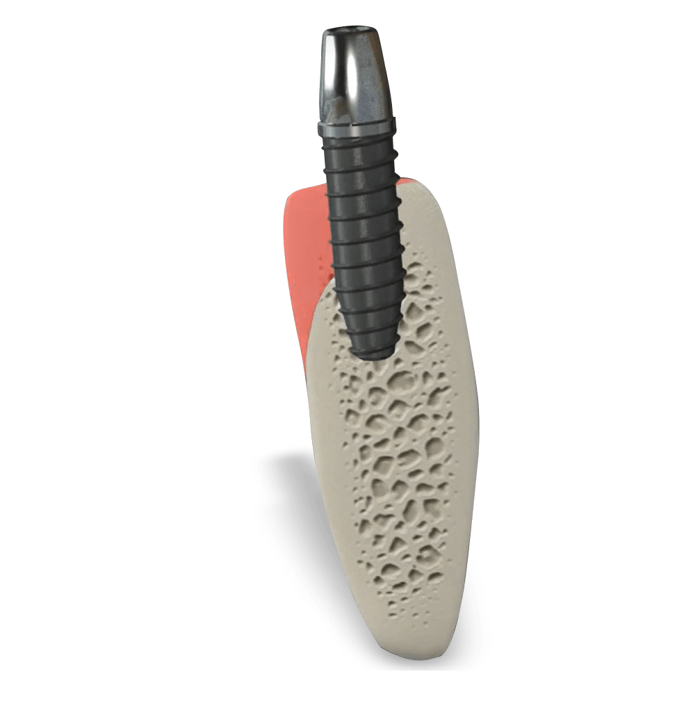 Missing Bone Illustration