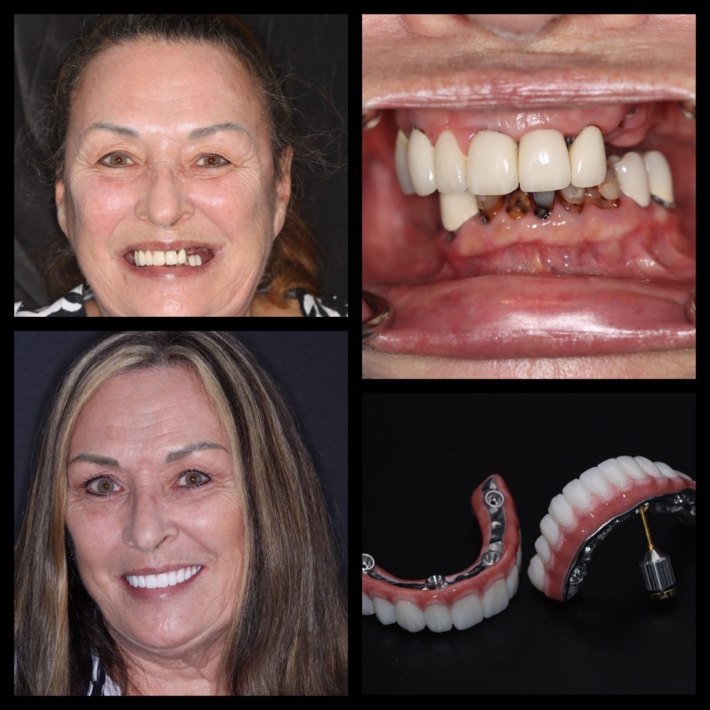 Compliation of 4 photos of a patient. Before and after photos and photo of dental implants.