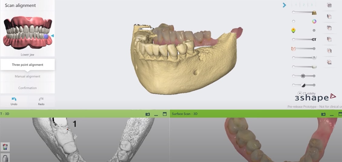 Model of dental implants generated in a software