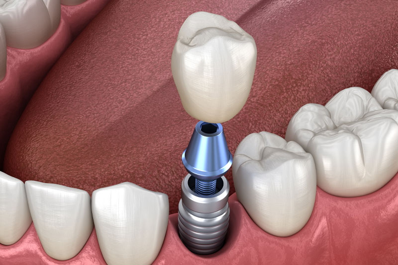 Dental Implant