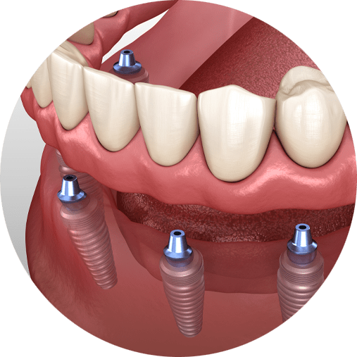 Dental Implants Model