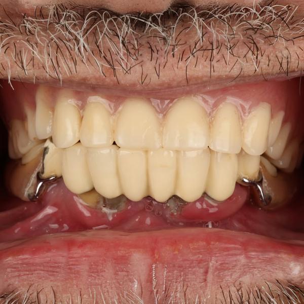 Close-up of a person's mouth showing upper and lower dental prosthetics with visible metal clasps and natural gum tissue.