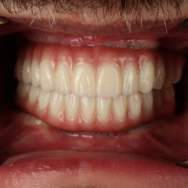 Close-up of a person's mouth showing a full set of upper and lower dentures with natural-looking teeth and healthy gums.
