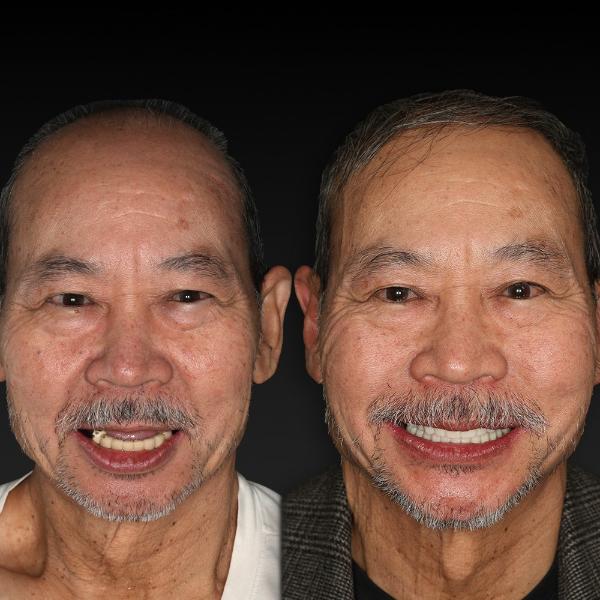 Side-by-side photos of an older man before and after dental treatment, showing noticeable improvements in his teeth and smile.