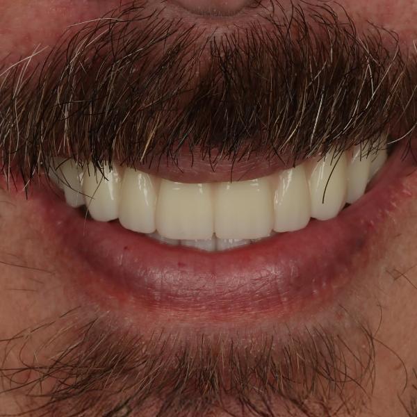 Close-up of a man's mouth with a mustache and beard, showing white, evenly aligned upper front teeth in a smile.