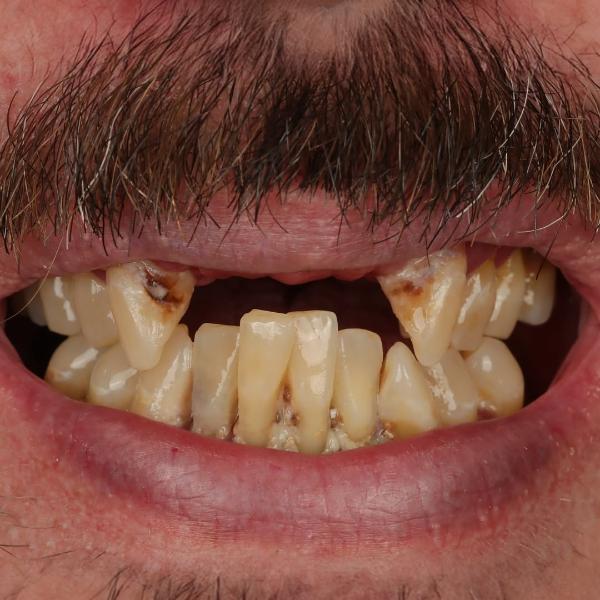 Close-up of a person's mouth showing stained, decayed, and misaligned teeth with visible plaque and gum recession.