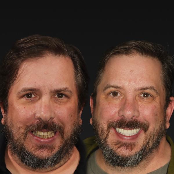 Two photos of the same man side by side; on the left, his teeth are uneven and discolored, and on the right, his teeth appear even, white, and restored, both with a neutral background.