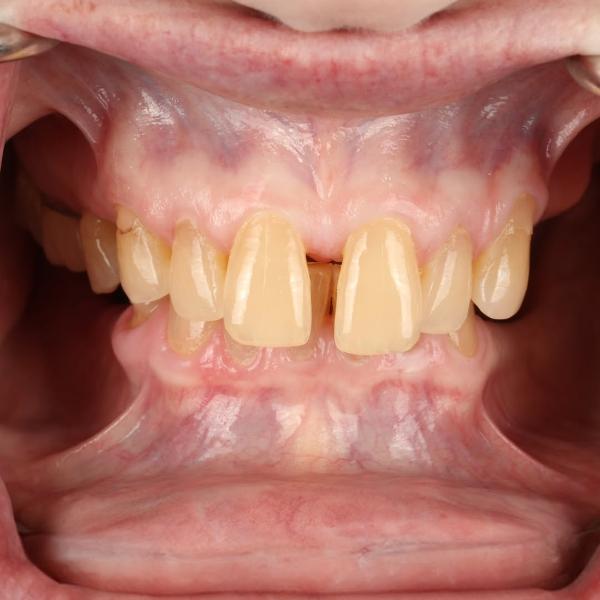 Close-up of an open mouth showing misaligned and yellowed upper and lower teeth, with visible gums and dental crowding.