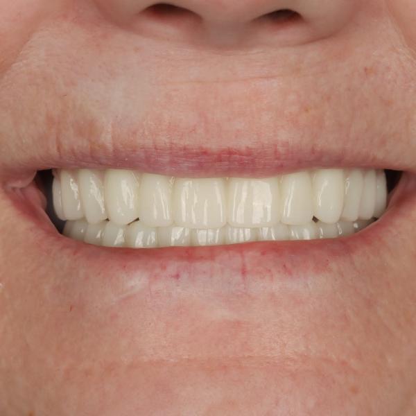 Close-up of a person's mouth showing a smile with straight, white teeth and light skin.