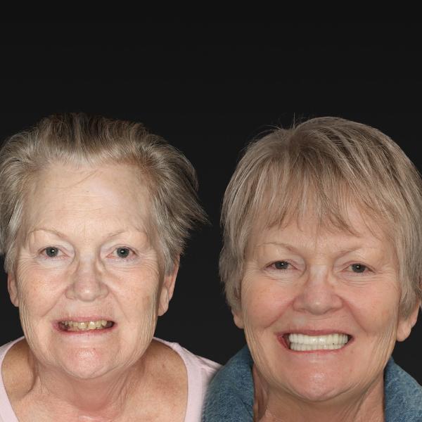 Side-by-side portraits of an older woman before and after dental treatment, showing missing teeth in the first image and a full smile in the second.