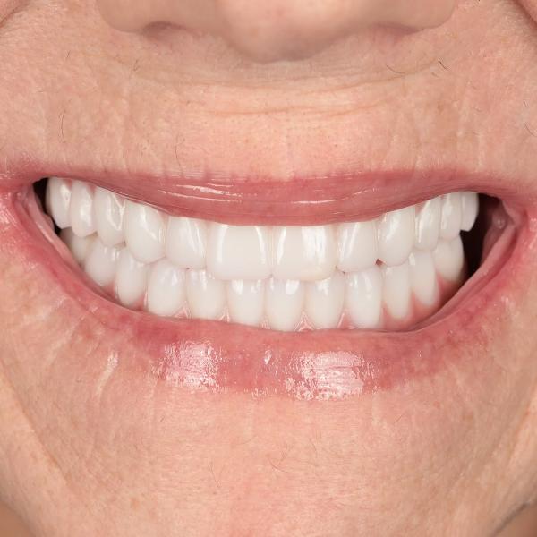 Close-up of a person's mouth smiling, showing clean, straight, and white teeth with visible upper and lower gums.