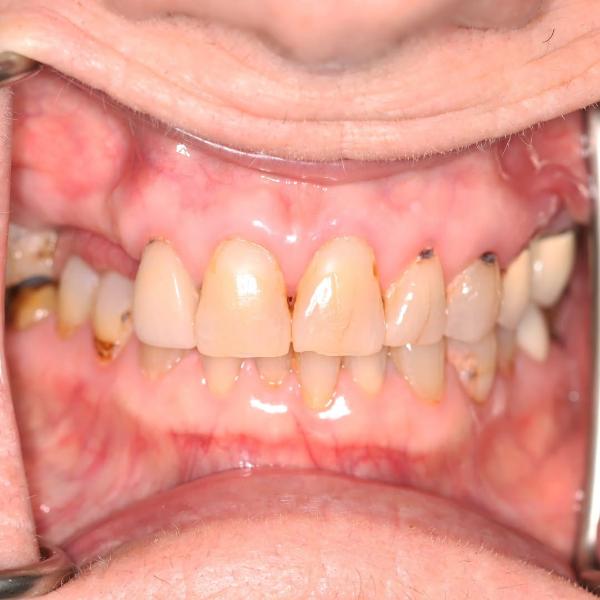 Close-up of an open mouth showing discolored, misaligned teeth with visible tartar buildup and gum inflammation.