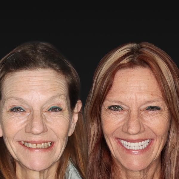 Side-by-side portraits of the same woman before and after cosmetic dental work, showing a notable improvement in her smile and dental appearance.