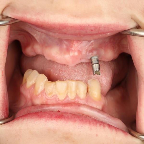 Close-up of an open mouth showing a dental implant post in the upper gum and missing upper front teeth, with dental retractors holding the lips aside.