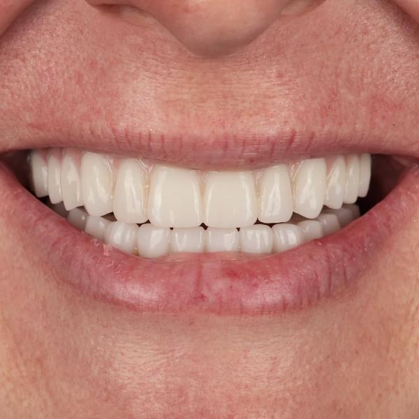 Close-up of a person's mouth showing clean, straight, white teeth and slightly parted lips.
