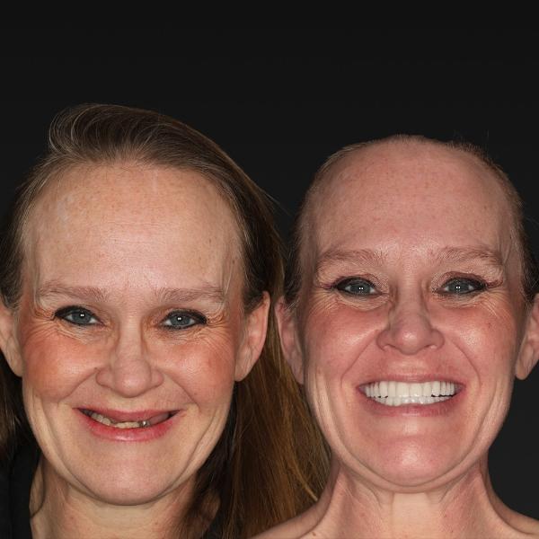 Two women with similar facial features stand side by side; one has long brown hair, the other is bald. Both are smiling and facing the camera against a plain dark background.