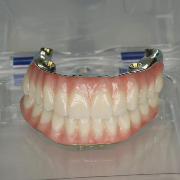 A set of upper and lower artificial dentures with a metal framework, displayed in a clear plastic case.