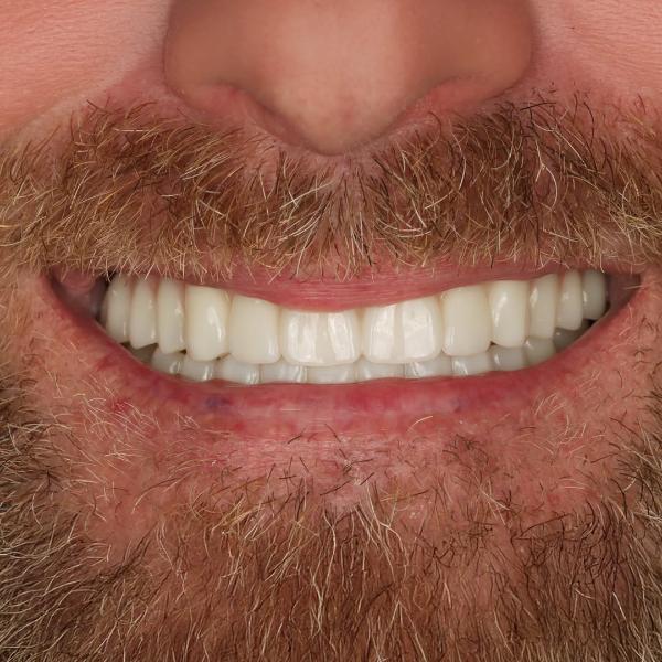 Close-up of a man's lower face with a full beard and mustache, showing a wide smile with straight, white teeth.