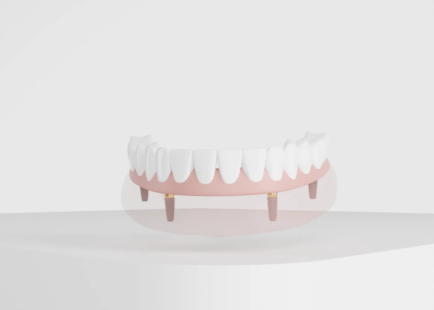 A digital rendering of a lower dental prosthesis with four visible dental implants attached to artificial gums and teeth.