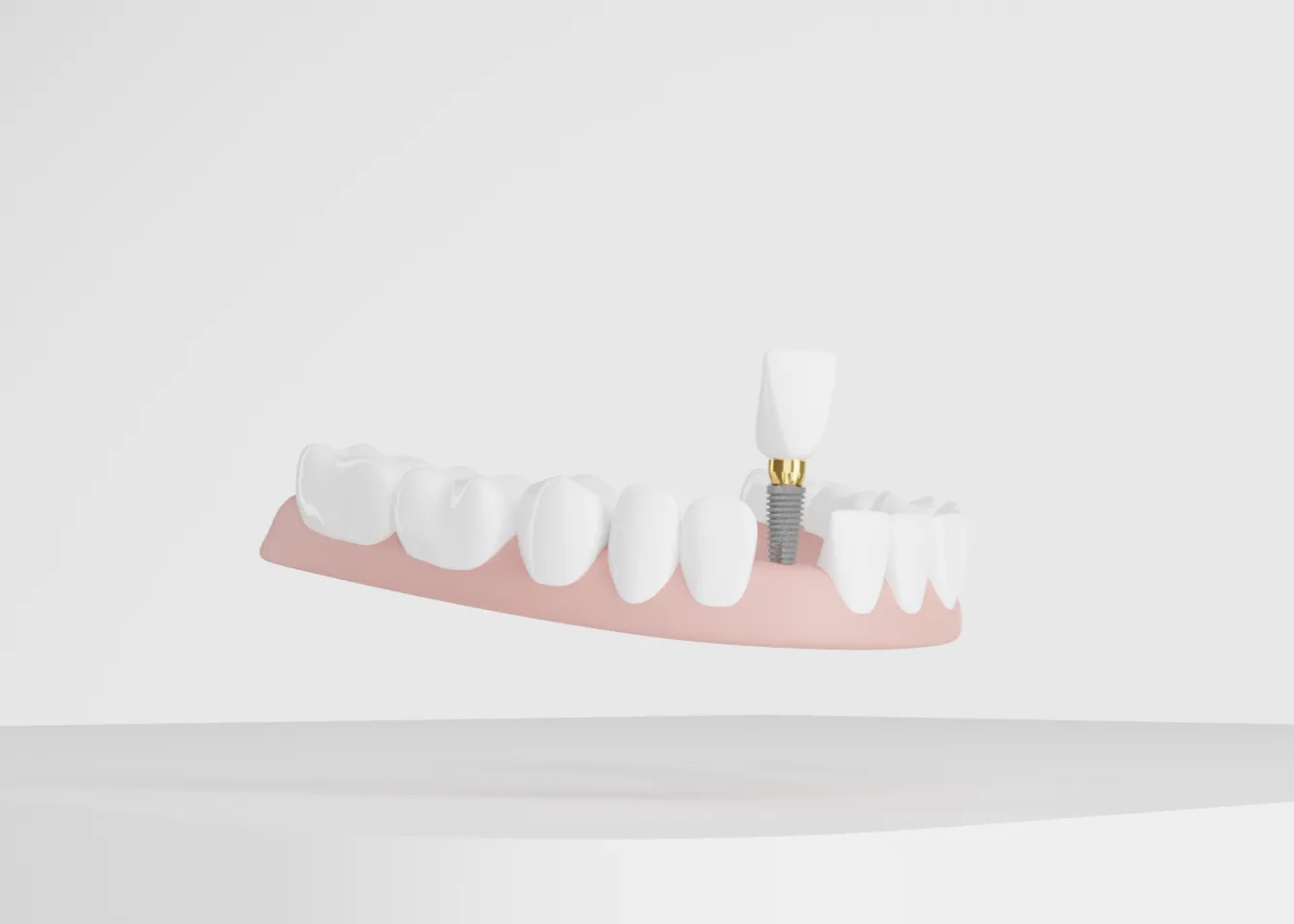 A 3D illustration of a dental implant being placed in the lower jaw, showing the gum, teeth, and implant components.