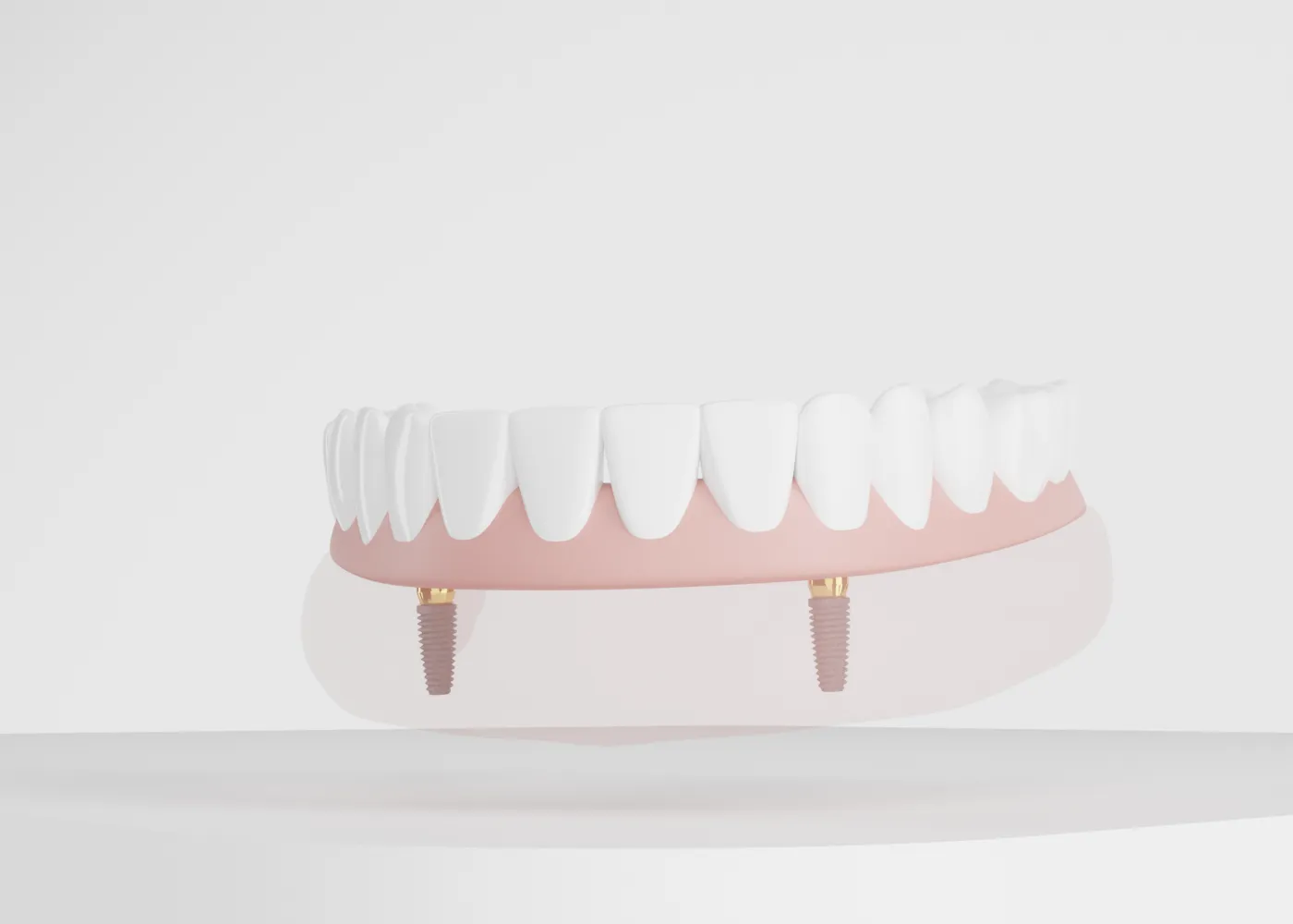 3D illustration of a dental prosthesis attached to two dental implants in a model of the lower jaw, displaying teeth and gum structure.