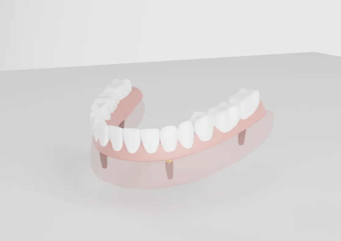 A 3D-rendered model of a lower dental prosthesis with white teeth, pink gums, and two visible gold dental implants on a neutral background.