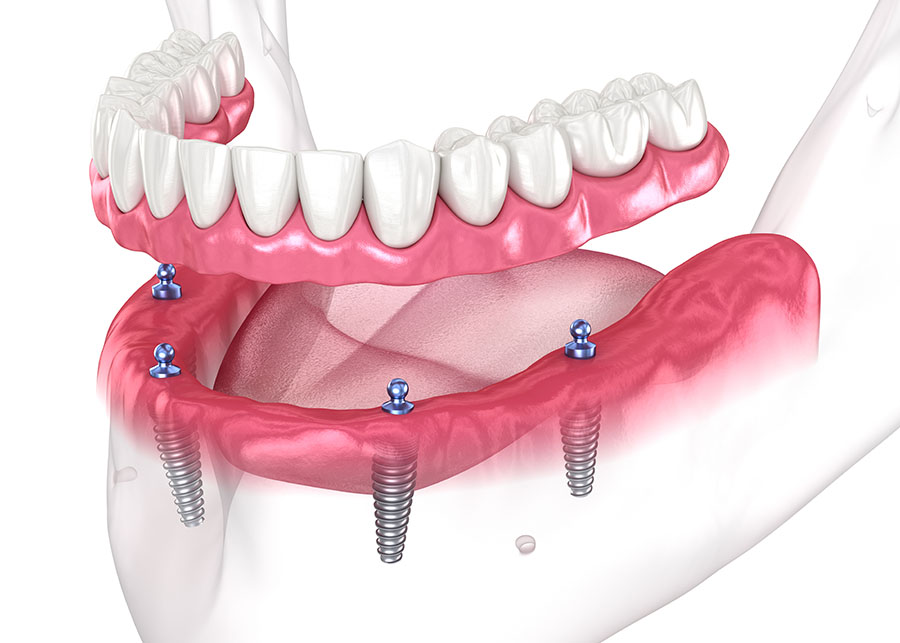 A digital illustration shows a lower jaw with four dental implants and an overdenture positioned above, demonstrating how the denture attaches to the implants.