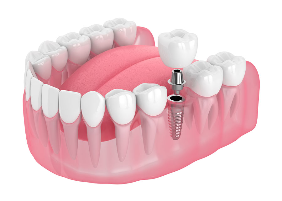 A 3D illustration of a lower jaw showing a dental implant being inserted where a tooth is missing.
