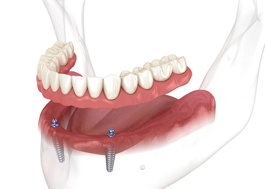 A digital illustration shows a lower jaw with two dental implants and an overdenture positioned above, ready to attach to the implants.