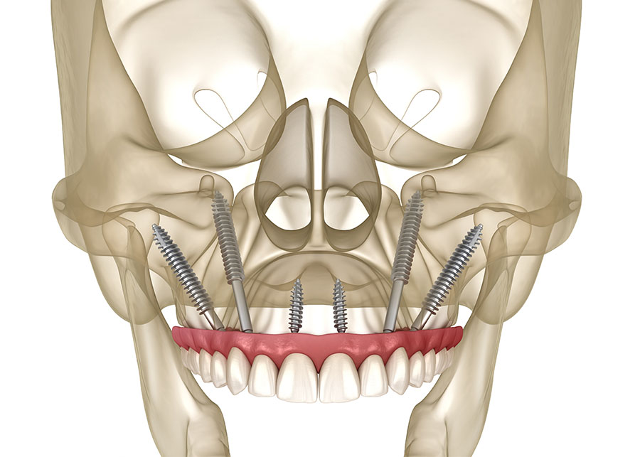 3D illustration of a human skull showing six dental implants inserted at angles into the upper jaw, replacing upper teeth.