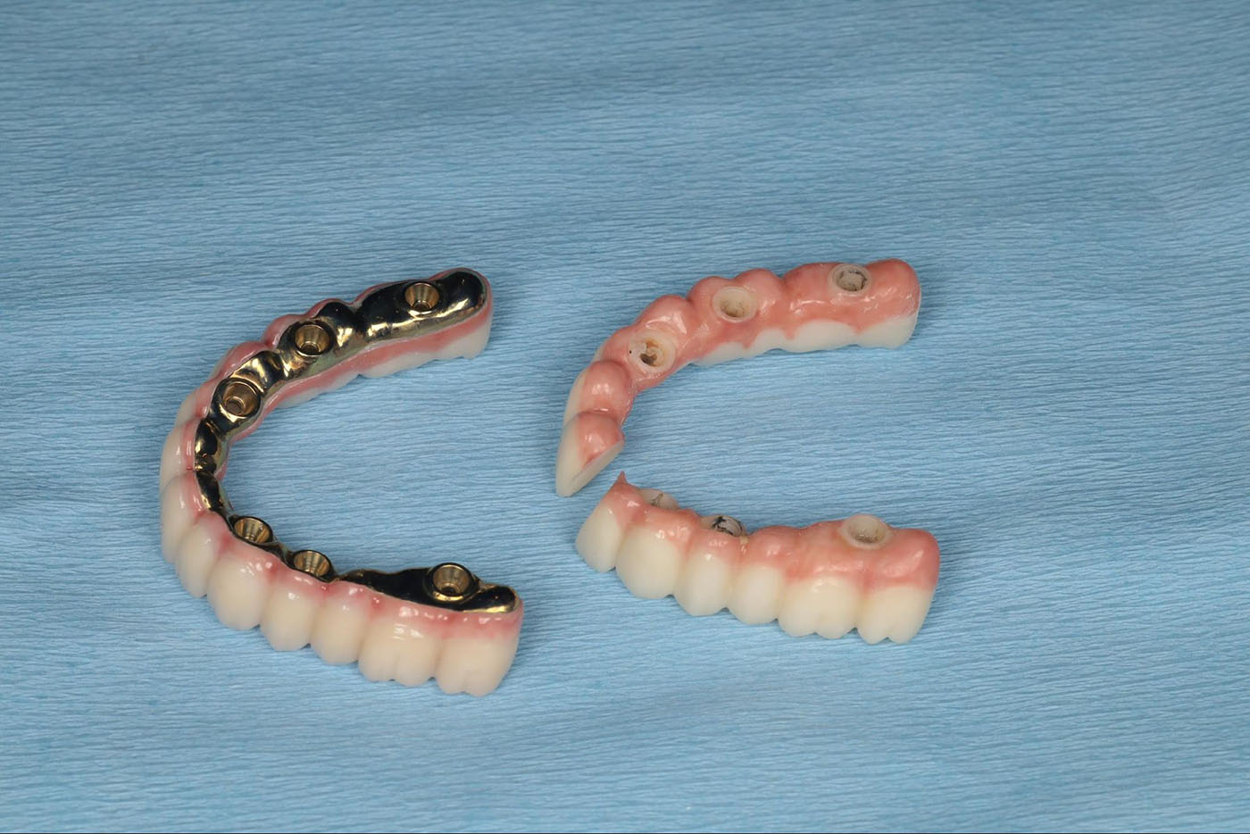 upper artificial dentures with a metal framework, displayed in a clear plastic case.