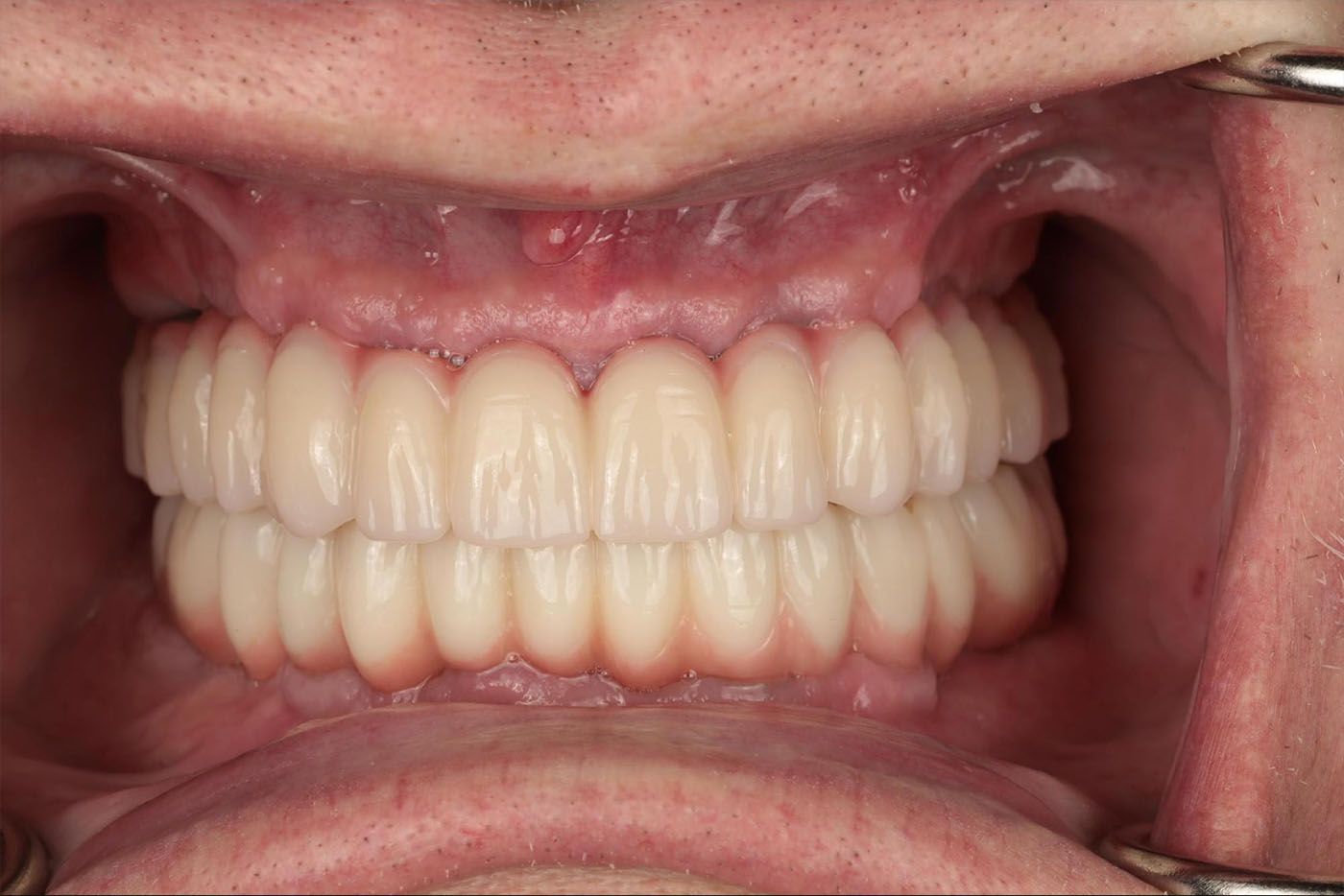 Close-up of a person's mouth showing a full set of upper and lower dentures with natural-looking teeth and healthy gums.