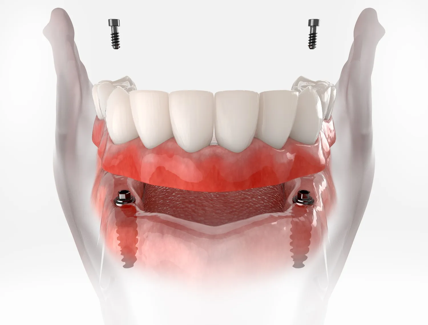 Snap-On Denture