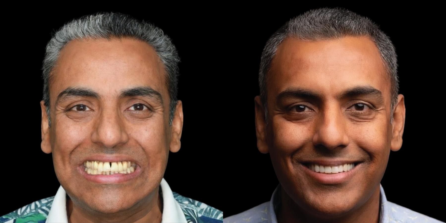 Before and after, man smiling against a black background.