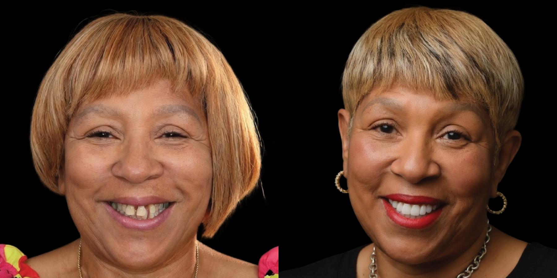 Before and after, woman smiling against a black background.